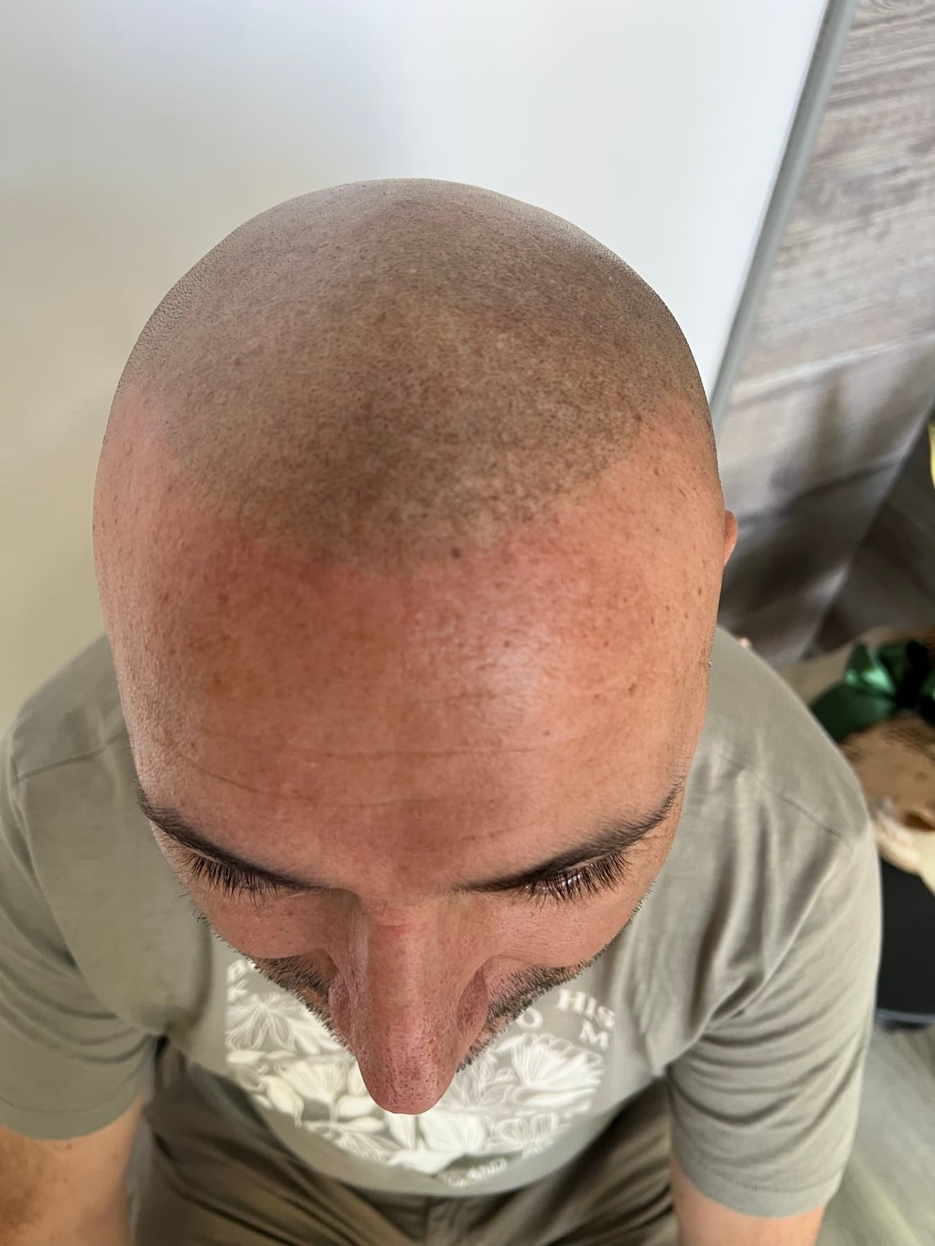 Caso Pigmento: Effetto rasato naturale