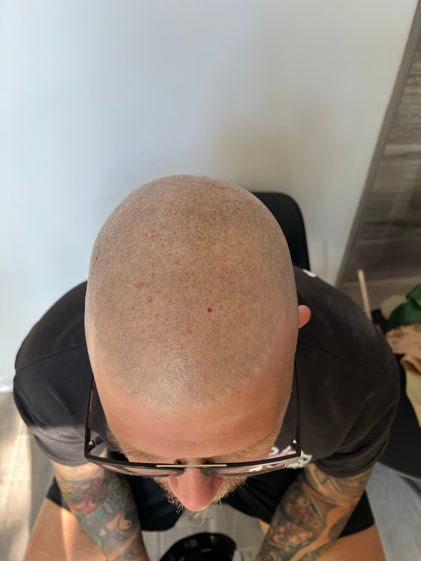 Caso Pigmento: Hairline sfumata